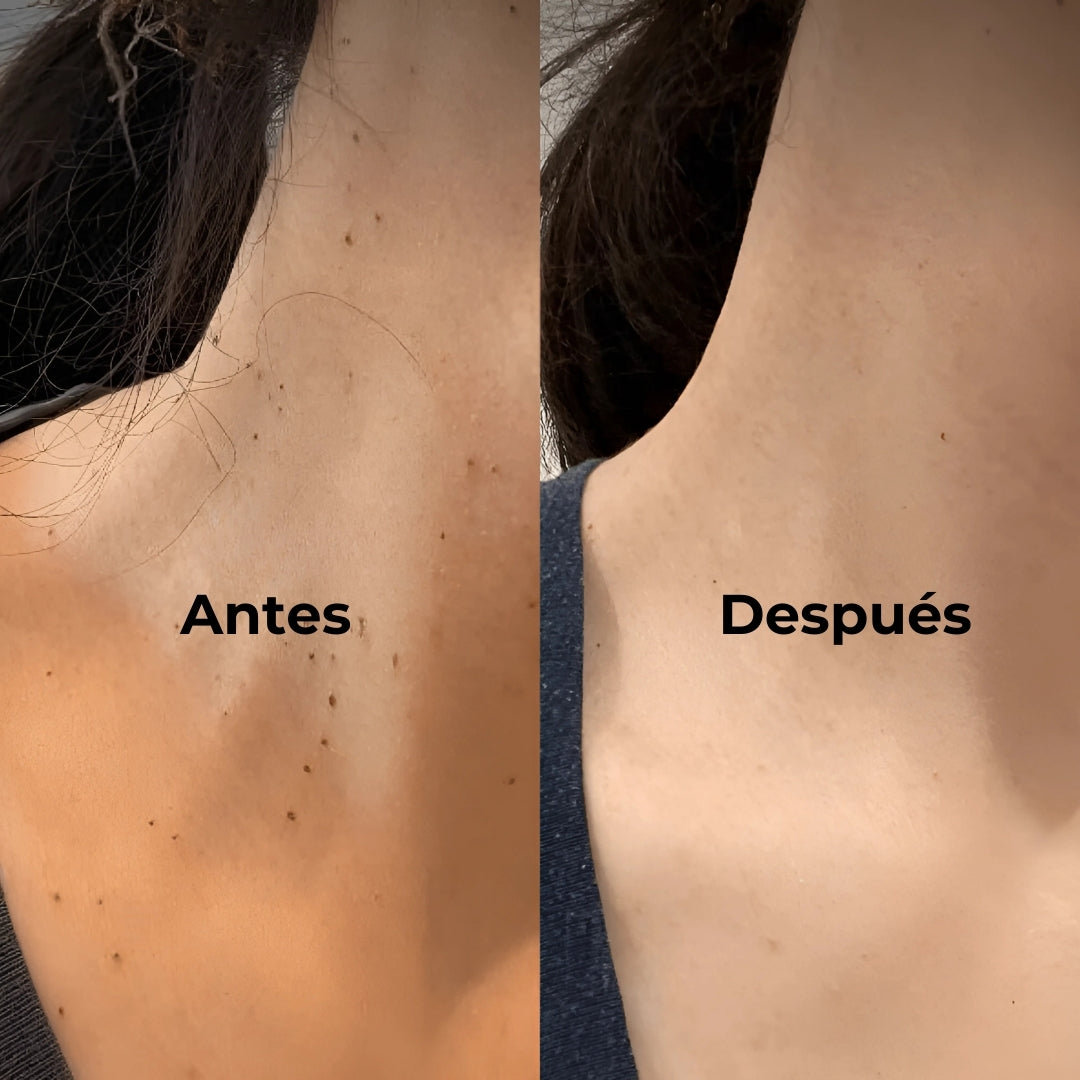 L U M I V I V E Plasma Pen - Dile Adiós a las Imperfecciones de la Piel Desde Casa